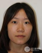 伊w兰注射隆鼻果如何？真实案例来说话！