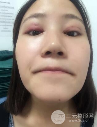 伊w兰注射隆鼻果3
