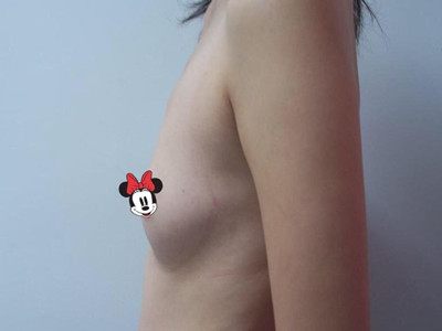 宜昌中爱张宜彬医生给我做的假体隆胸手术，分享一下前后照片