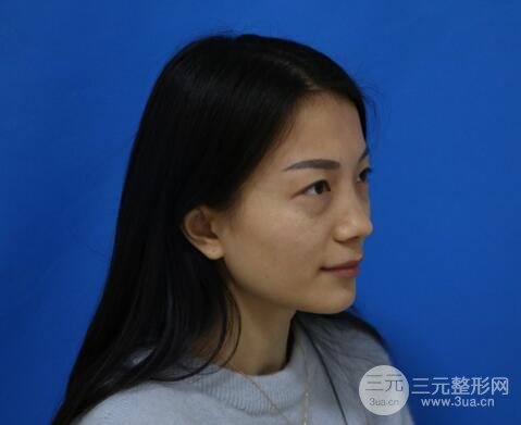 射频去眼袋多少钱2