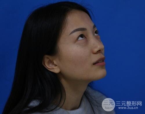 射频去眼袋多少钱3