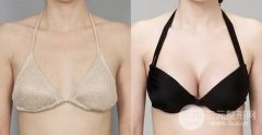 隆胸手术影响哺乳吗|隆胸前后对比照片