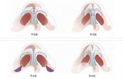 鼻头缩小手术价格|鼻部整形项目参考价格分享