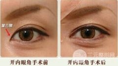 开眼角手术降低风险么|开眼角和不开的区别图