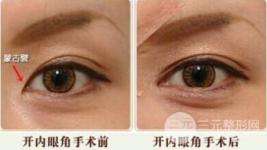 开眼角手术降低风险么|开眼角和不开的区别图
