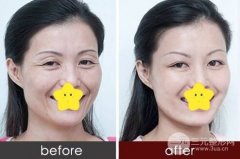 眼睛长细纹了怎么办|去眼纹的办法有哪些