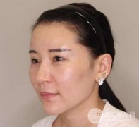 南京米尚恩鼻部整形|自体肋软骨隆鼻鼻部微调翘挺美鼻 南京米尚恩鼻部整形|自体肋软骨隆鼻鼻部微调翘挺美鼻
