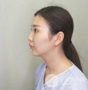 南京米尚恩韩式生科|假体隆鼻鼻部塑造一个月恢复果