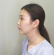 南京米尚恩韩式生科|假体隆鼻鼻部塑造一个月恢复果 南京米尚恩韩式生科|假体隆鼻鼻部塑造一个月恢复果
