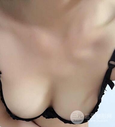 自体脂肪隆胸8