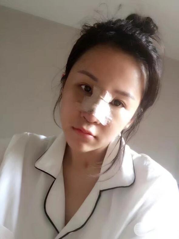 假体隆鼻真实术前术后前后对比恢复图照片 分享