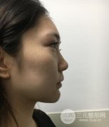 上海百*丽眼隆鼻整形|祛眼袋+假体隆鼻整形组合塑造年轻美颜