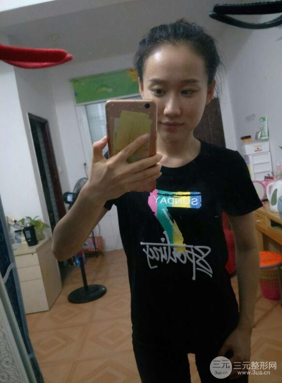 自体脂肪填充全脸恢复前后效果对比图案例分享 少女感怎么来