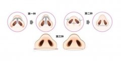 鼻孔缩小手术对比图分享
