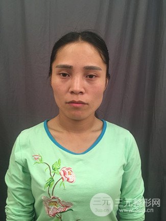 上海华美整形价格表|颧骨内推+长曲线下颌角手术案例分享