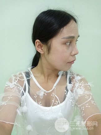 上海华美整形价格表|颧骨内推+长曲线下颌角手术案例分享