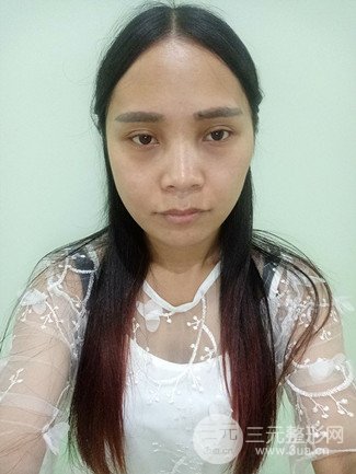 上海华美整形价格表|颧骨内推+长曲线下颌角手术案例分享