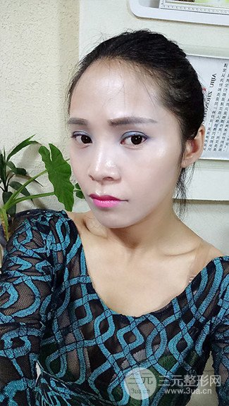 上海华美整形价格表|颧骨内推+长曲线下颌角手术案例分享