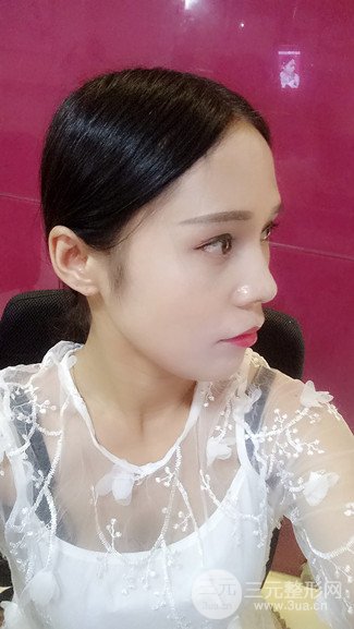 上海华美整形价格表|颧骨内推+长曲线下颌角手术案例分享