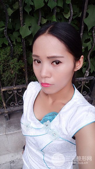 上海华美整形价格表|颧骨内推+长曲线下颌角手术案例分享