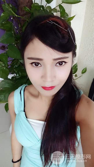 上海华美整形价格表|颧骨内推+长曲线下颌角手术案例分享