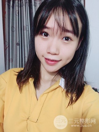 广州健丽整形价格表|不开刀双眼皮前后对比图分享