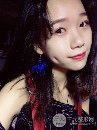 广州健丽整形价格表|不开刀双眼皮前后对比图分享