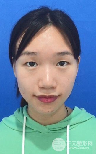 广州健丽整形价格表|不开刀双眼皮前后对比图分享
