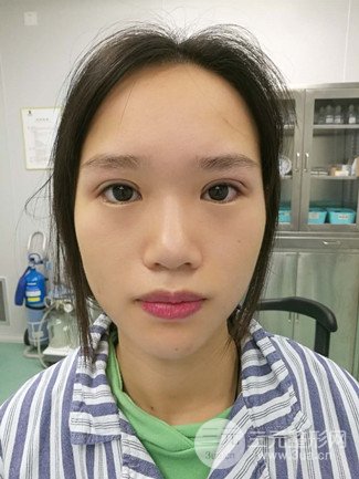 广州健丽整形价格表|不开刀双眼皮前后对比图分享