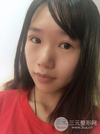广州健丽整形价格表|不开刀双眼皮前后对比图分享