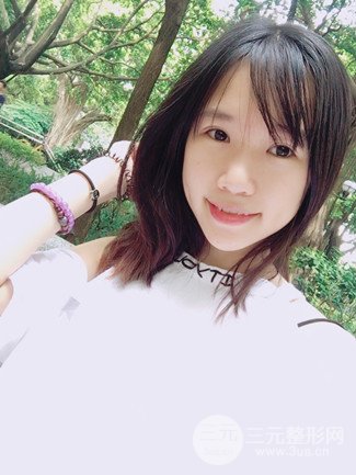 广州健丽整形价格表|不开刀双眼皮前后对比图分享
