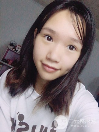 广州健丽整形价格表|不开刀双眼皮前后对比图分享