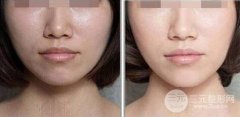 光子嫩肤的优势|光子嫩肤多少钱一次