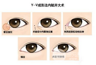 伊美尔做双眼皮怎么样