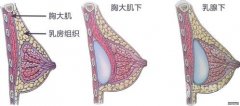 上海曼托假体隆胸的价格 手感怎么样