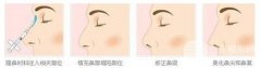 伊w兰隆鼻价格