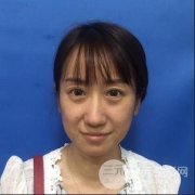 缓解鱼尾纹的方法_案例分享，附上海华美整形美容医院价格详情