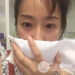 缓解鱼尾纹的方法4