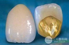 黄金烤瓷牙价格，价格贵吗?