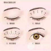 生物焊接双眼皮的价格是多少？附案例果对比图片分享~