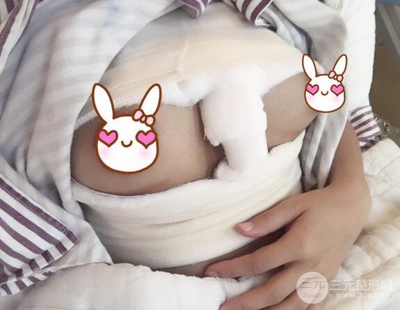 娜高假体隆胸多少钱3
