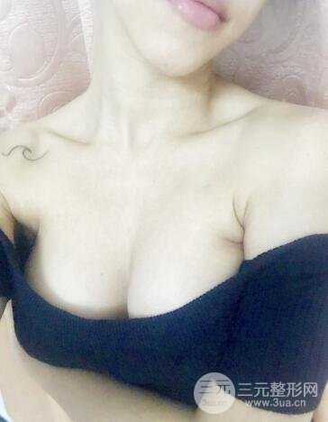 娜高假体隆胸多少钱7