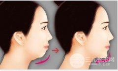 北京做假体垫下巴手术要多少钱？附上恢复期注意事项