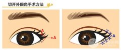 开内眼角会回缩吗 果好不好