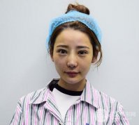 【隆鼻修复】MISKO隆鼻恢复过程_术前术后对比图