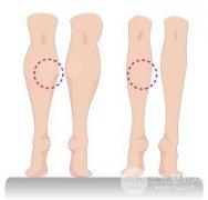 打注射瘦腿要多少钱 瘦腿果好不好