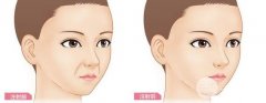 有法令纹怎么办  去除的方法有哪些