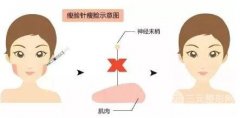 B****能维持多长时间？需要注射几次才能定型？有什么副作用？
