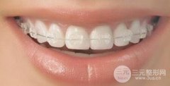 无托槽隐形矫治价格