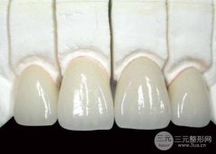 科普：贵金属烤瓷牙的种类有哪些?